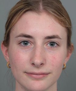 after rhinoplasty front view of female patient 6360