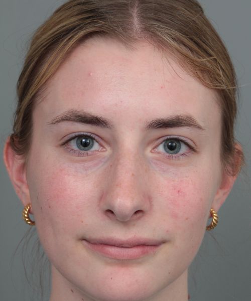 after rhinoplasty front view of female patient 6360