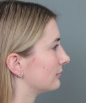 after rhinoplasty right side view of female patient 6360