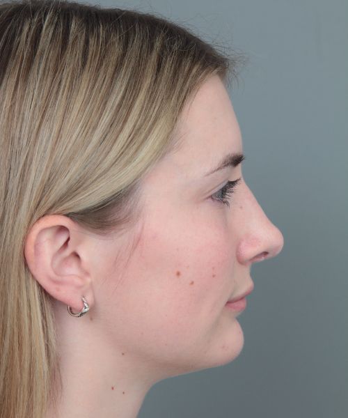 after rhinoplasty right side view of female patient 6360