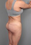 after thigh/buttock lift back right angle view of female patient 6377
