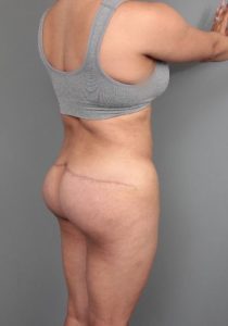 after thigh/buttock lift back right angle view of female patient 6377