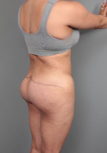after thigh/buttock lift back right angle view of female patient 6377