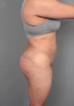 after thigh/buttock lift right side view of female patient 6377