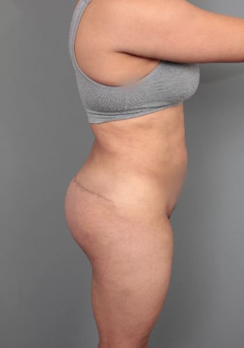 after thigh/buttock lift right side view of female patient 6377