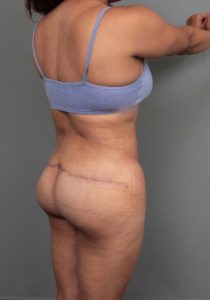before thigh/buttock lift back right angle view of female patient 6377