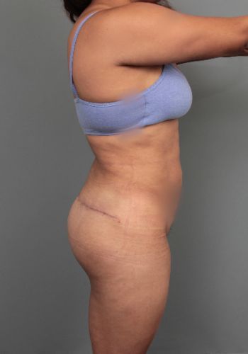 before thigh/buttock lift right side view of female patient 6377