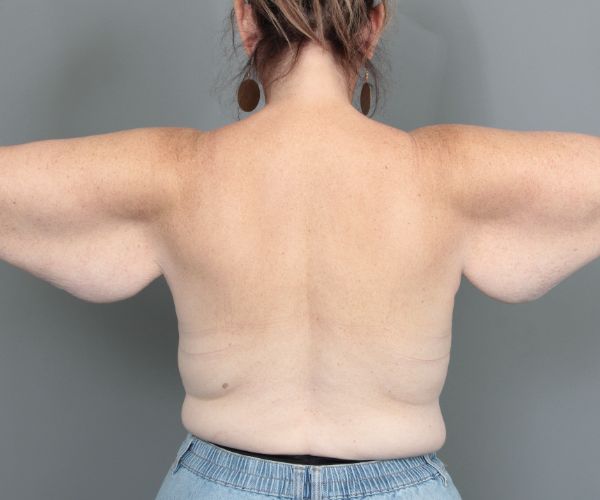 before arm lift back view of female patient 6463