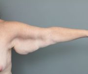 before arm lift left front view of female patient 6463