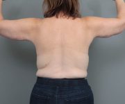 after arm lift back view of female patient 6463