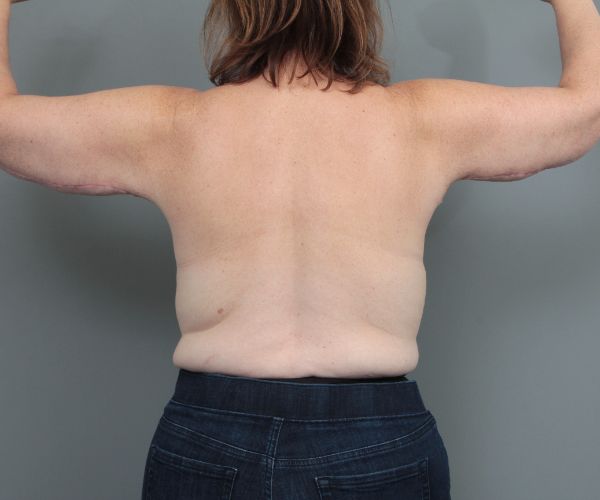 after arm lift back view of female patient 6463