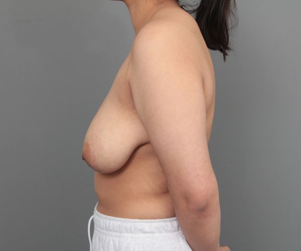 before breast reduction left side view of female patient 6523