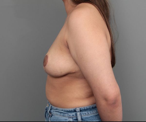 after breast reduction left side view of female patient 6523