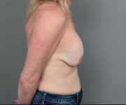 before breast revision right side view of female patient 6511