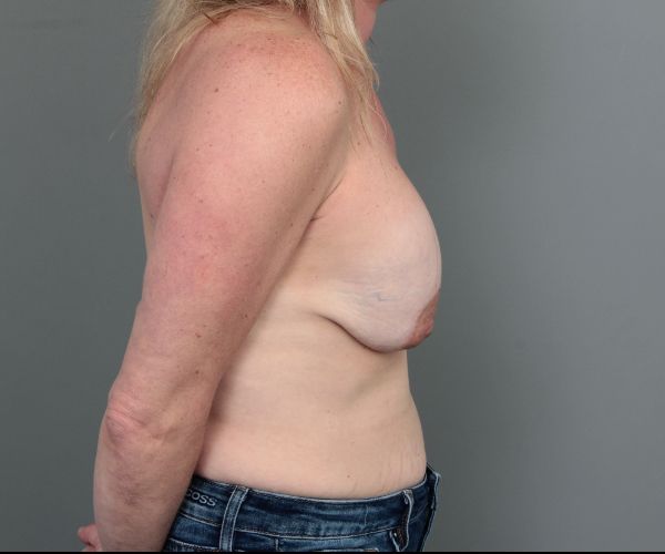 before breast revision right side view of female patient 6511