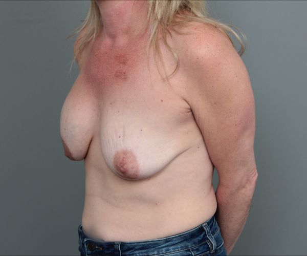 before breast revision left angle view of female patient 6511