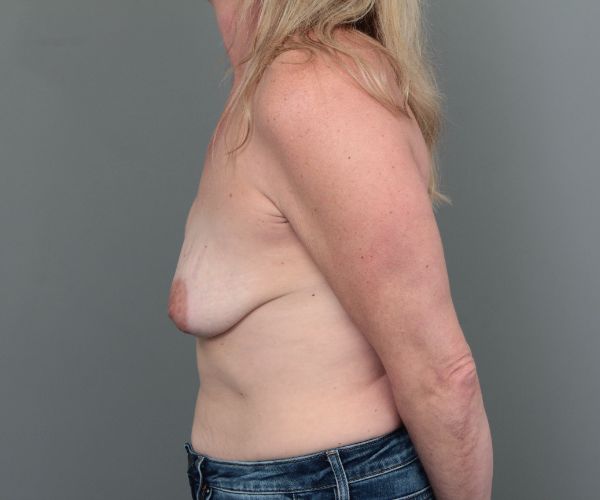 before breast revision left side view of female patient 6511