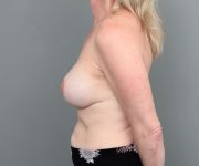 after breast revision left side view of female patient 6511
