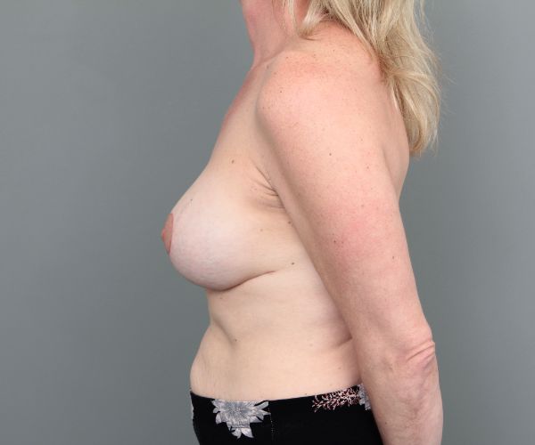 after breast revision left side view of female patient 6511