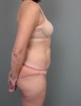 after liposuction right side view of female patient 6458
