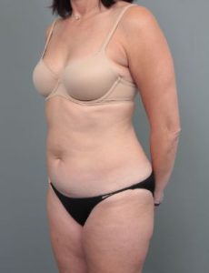 before liposuction left angle view of female patient 6458