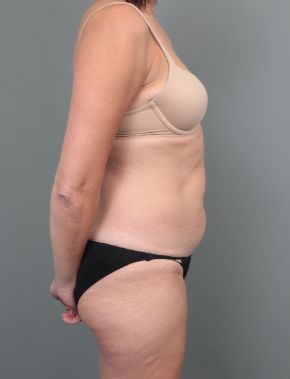 before liposuction right side view of female patient 6458