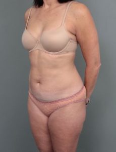 after liposuction left angle view of female patient 6458