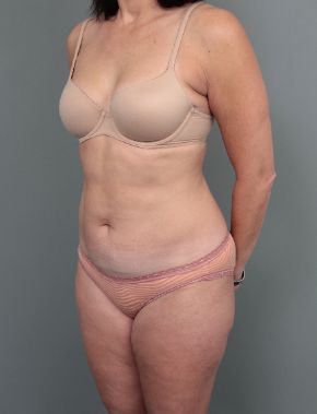 after liposuction left angle view of female patient 6458