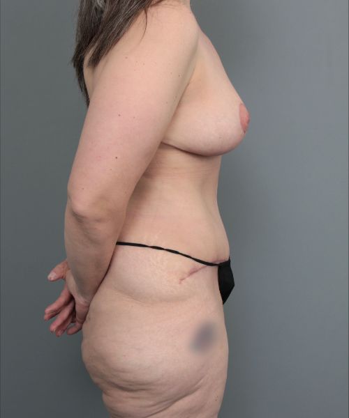after mommy makeover right side view of female patient 6473