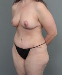 after mommy makeover left angle view of female patient 6473