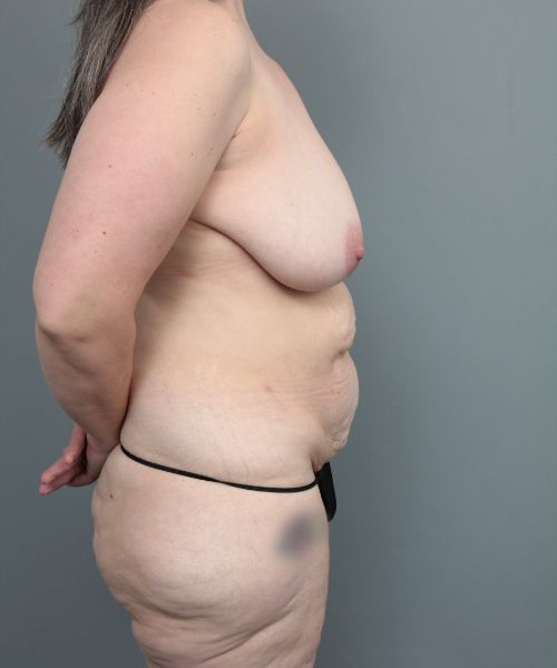 before mommy makeover right side view of female patient 6473