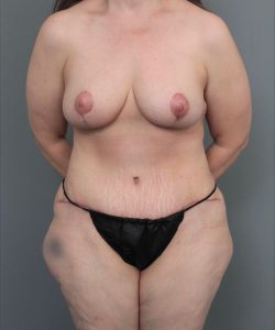 after mommy makeover front view of female patient 6473