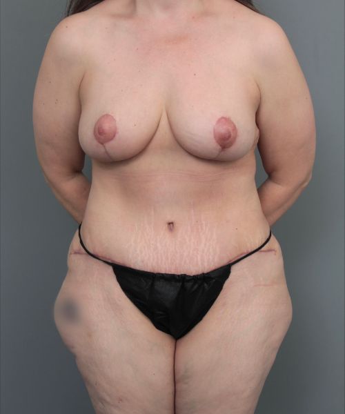 after mommy makeover front view of female patient 6473