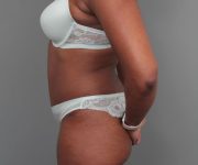 after tummy tuck left side view of female patient 6492