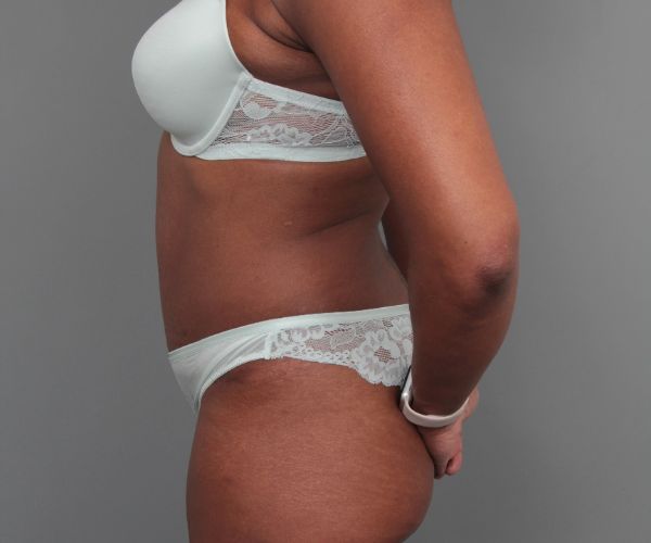after tummy tuck left side view of female patient 6492