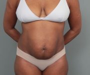 before tummy tuck front view of female patient 6492