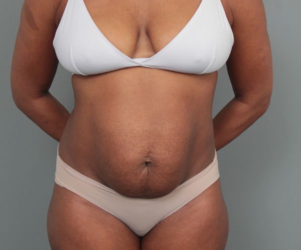 before tummy tuck front view of female patient 6492