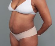 before tummy tuck left angle view of female patient 6492
