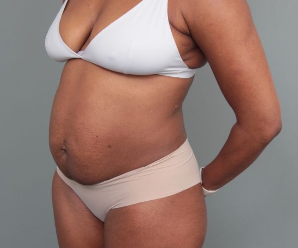 before tummy tuck left angle view of female patient 6492