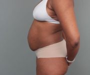 before tummy tuck left side view of female patient 6492