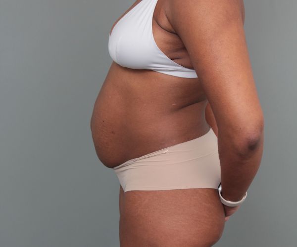 before tummy tuck left side view of female patient 6492