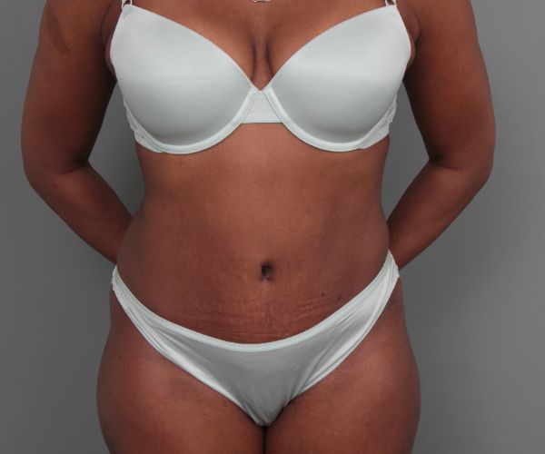after tummy tuck front view of female patient 6492