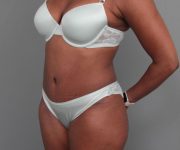 after tummy tuck left angle view of female patient 6492