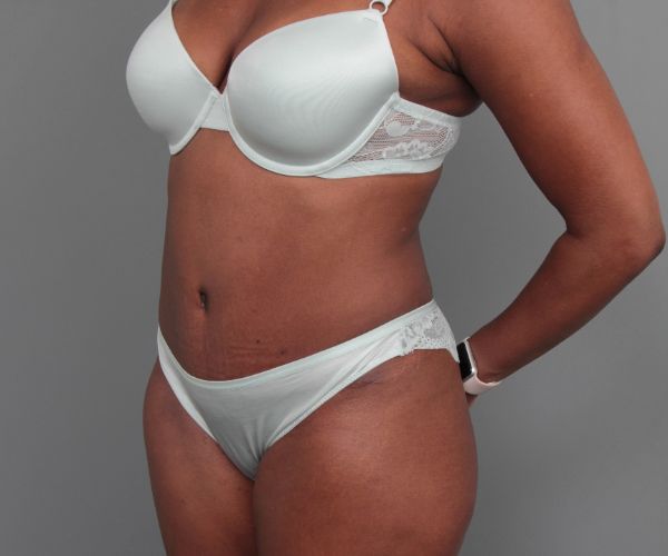 after tummy tuck left angle view of female patient 6492