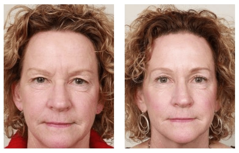 before and after shots of brow lift front view of female patient