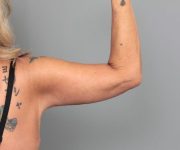after arm lift right back arm front view of female patient 6868