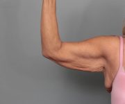 before arm lift right arm front view of female patient 6868