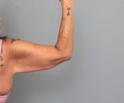 before arm lift right arm back view of female patient 6868
