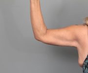 after arm lift left arm back view of female patient 6868
