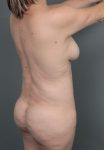 after Brazilian butt lift back right angle view of female patient 6874